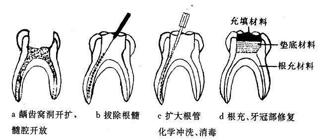 为什么说根管治疗的费用那么贵呢?