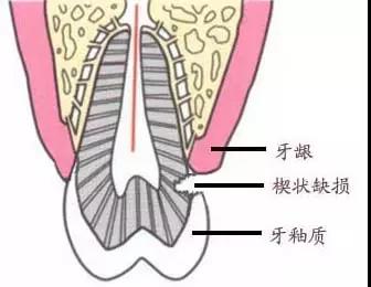 医学上称之为"楔状缺损"!