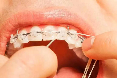 99%的人不知道牙套上的橡皮筋有啥用? 
