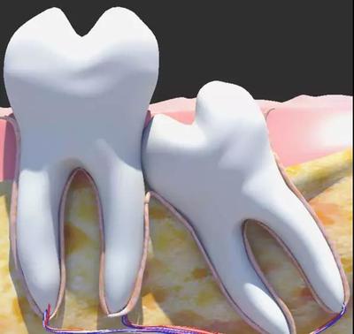 所謂智齒就是第三磨牙,也是最晚萌出的牙齒,它的萌出時間大多在18