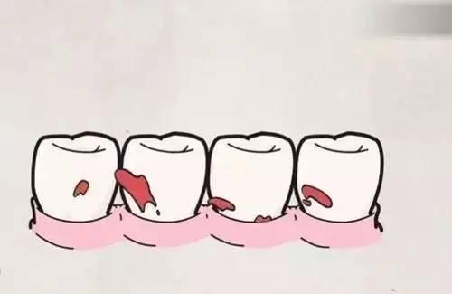 如何预防牙龈萎缩